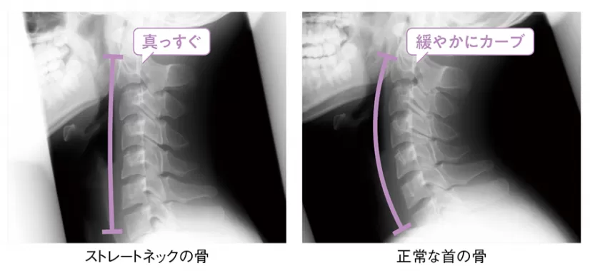 X線ストレートネック